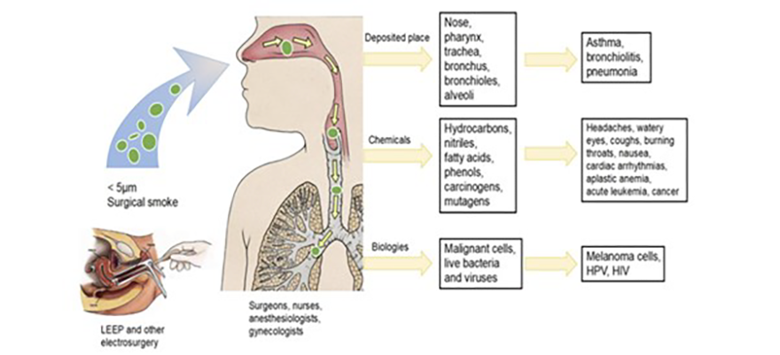 Surgical Smoke Figure 1